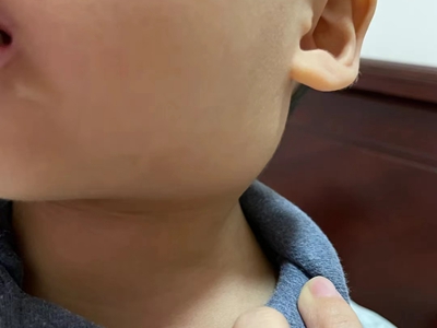 儿童痄腮症状表现 孩子长痄腮怎么处理