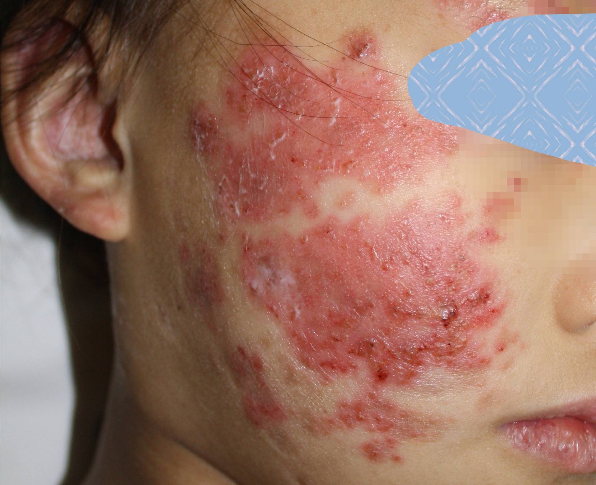 系统性红斑狼疮会传染吗 免疫系统异常会遗传吗