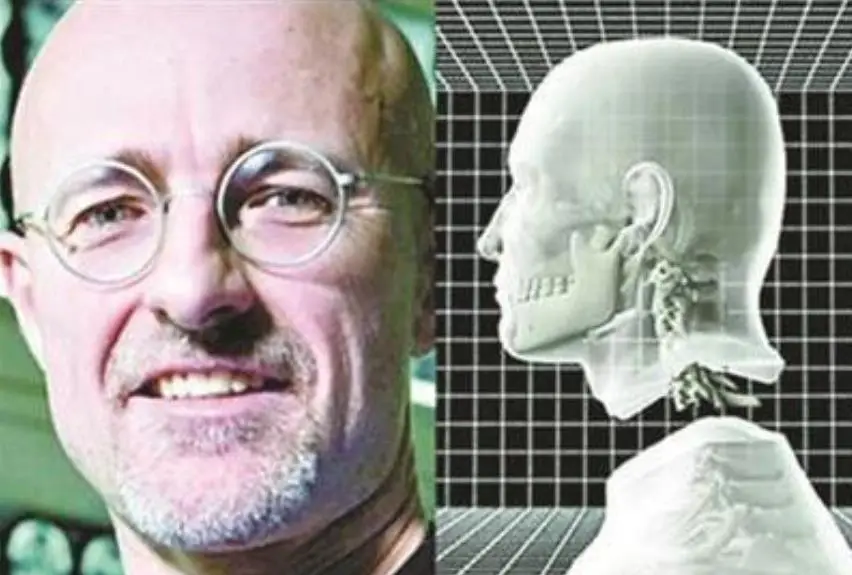 世界上首个想做换头手术的人,他现在怎么样呢?...