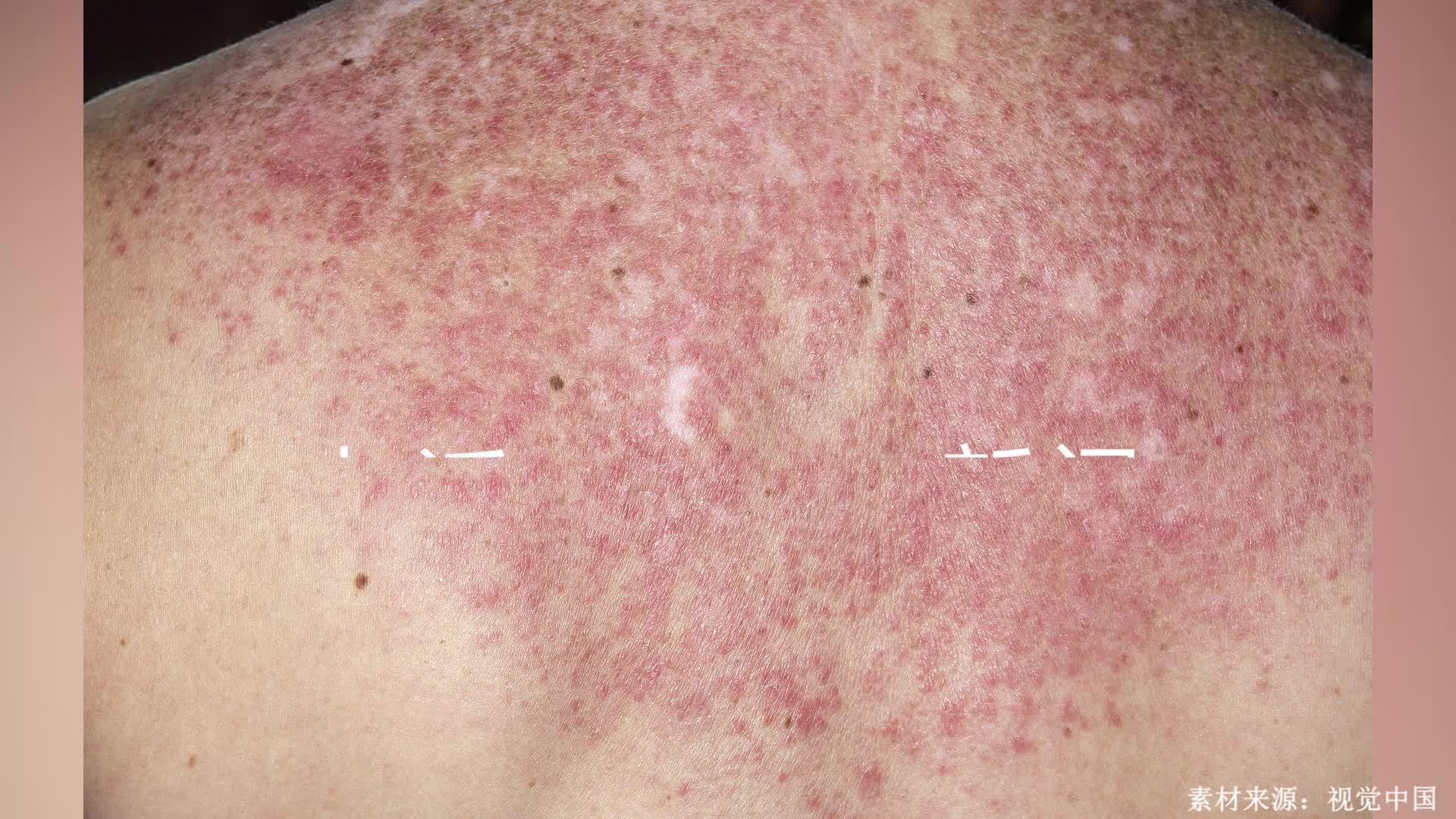 系统性红斑狼疮传染吗