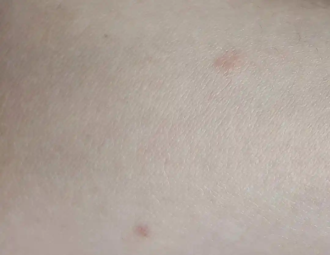 不痛不痒,竟然得了糖尿病?...