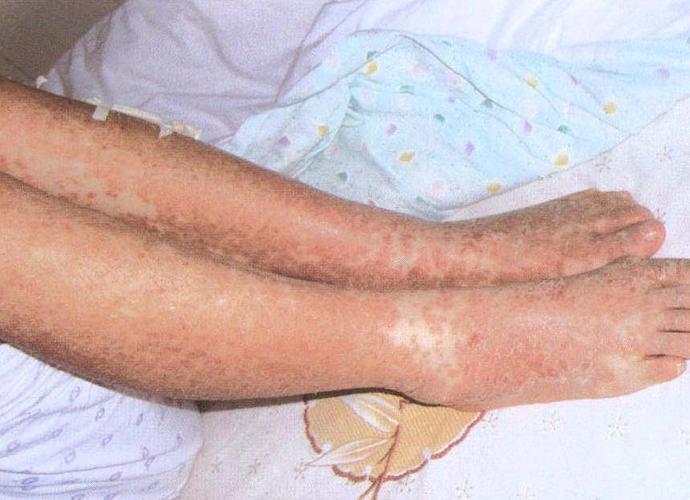 艾滋病治愈案例 人类离战胜艾滋还有多远