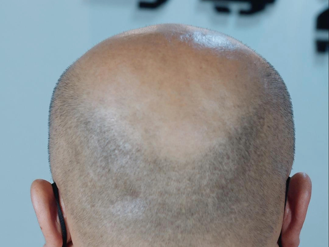 “我变秃了,也变强了”有科学根据吗?如何面对秃如其...
