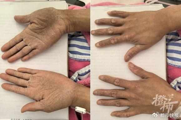 《傲慢与偏见》的作者简·奥斯汀死于砷中毒?...