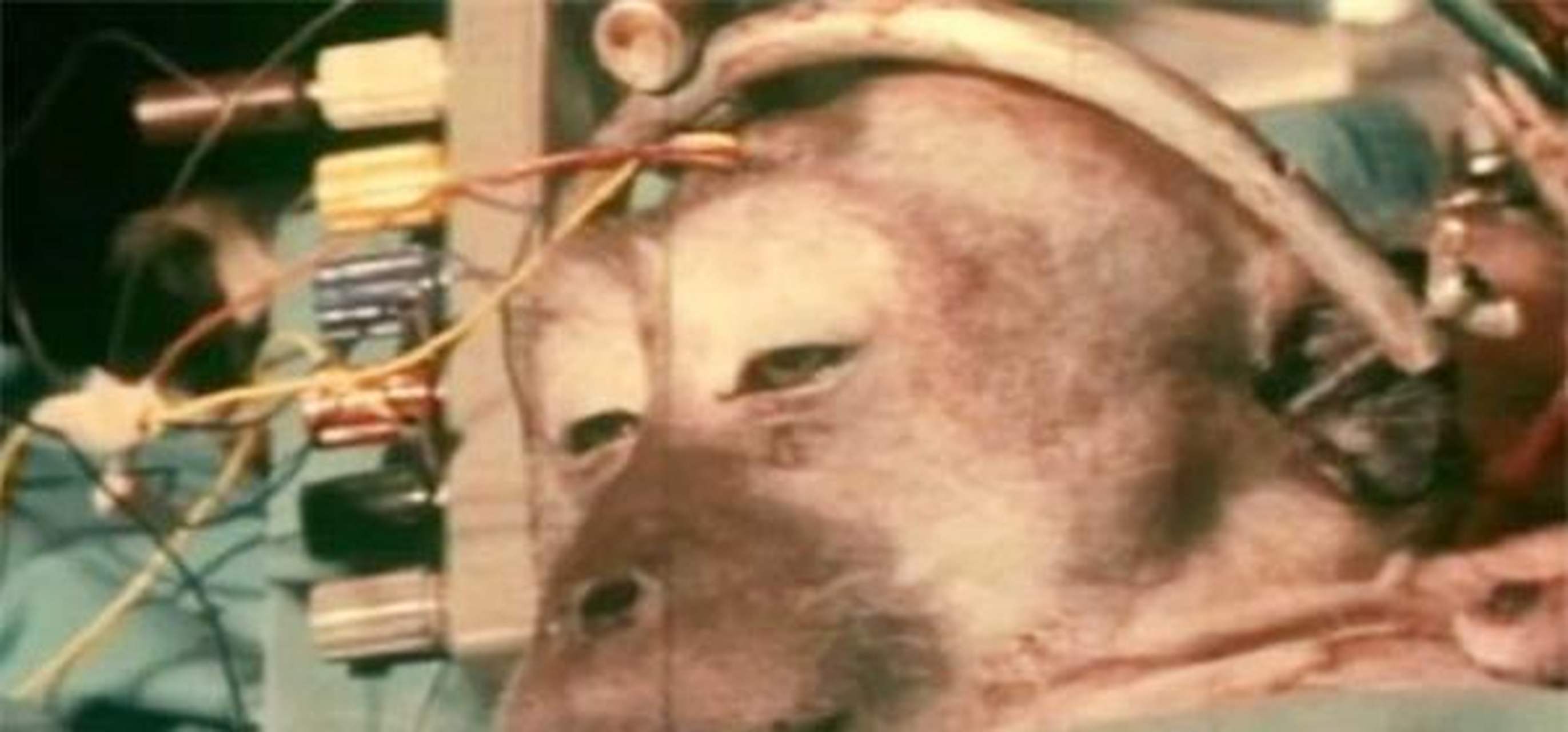 世界首例换头手术到底还活着吗？换头手术现状如何？