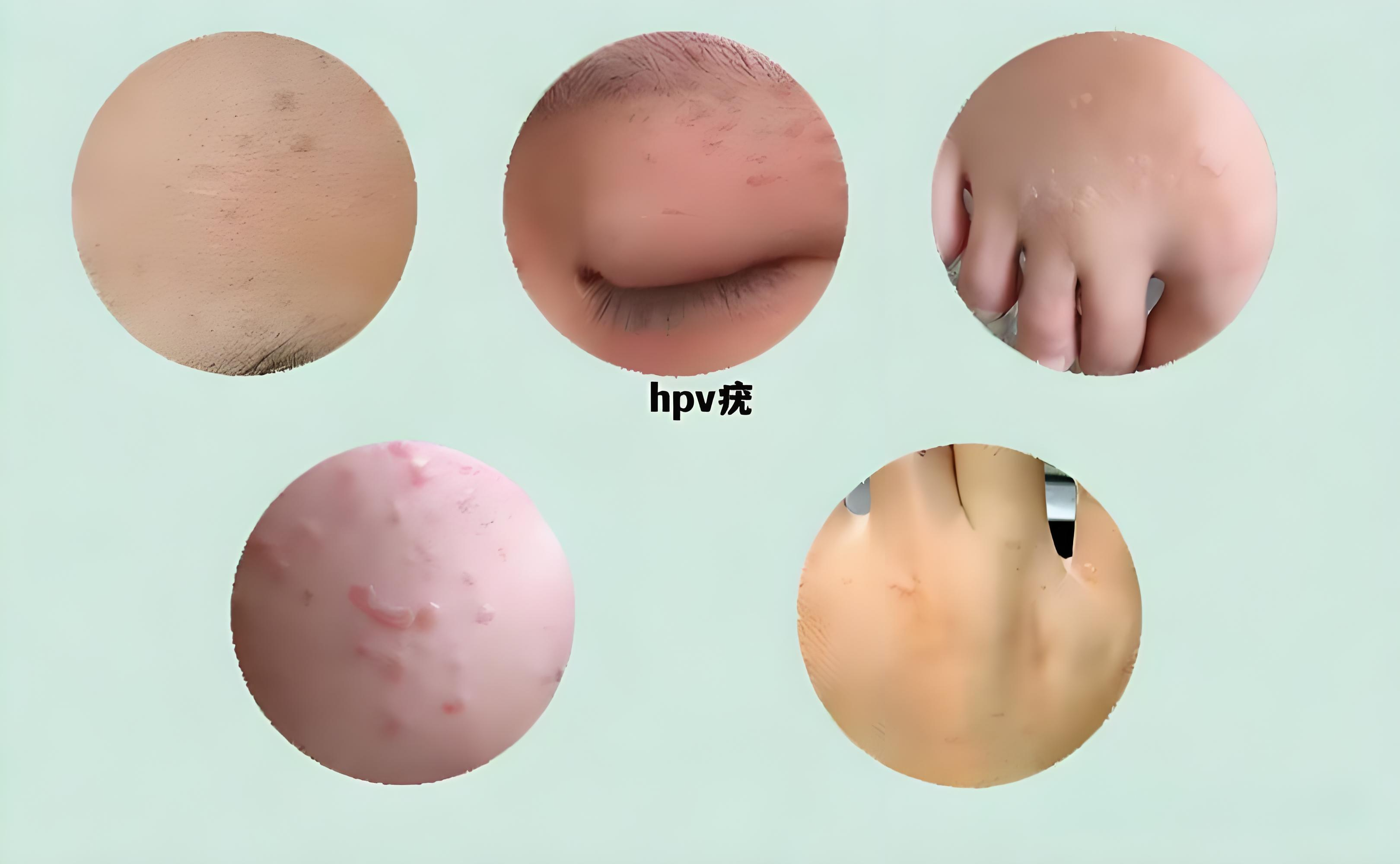 香港HPV九价疫苗安全吗 赴港打宫颈癌疫苗注意事项